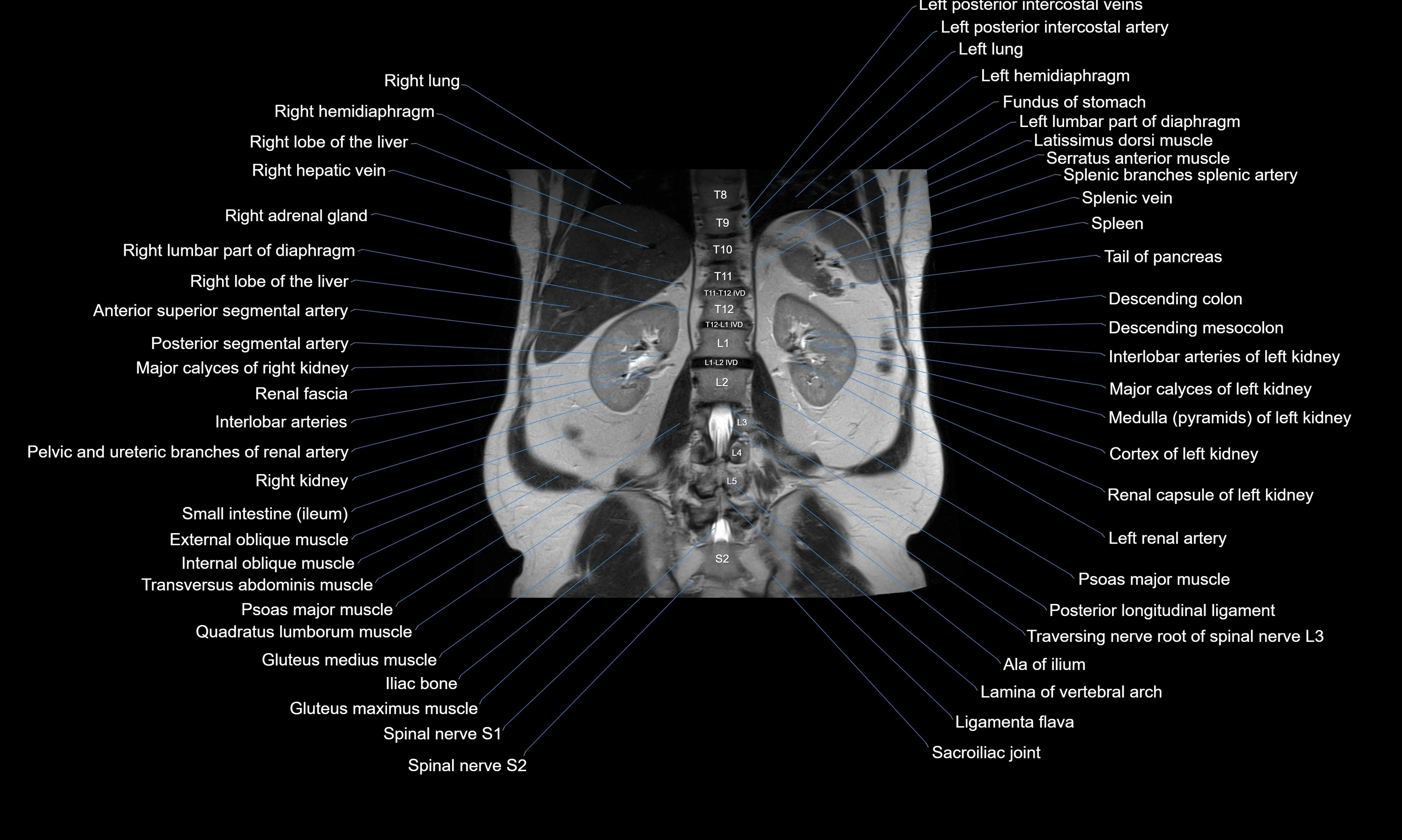MRI Abdomen axial cross sectional anatomy radiology  image-img-00001-00041.webp